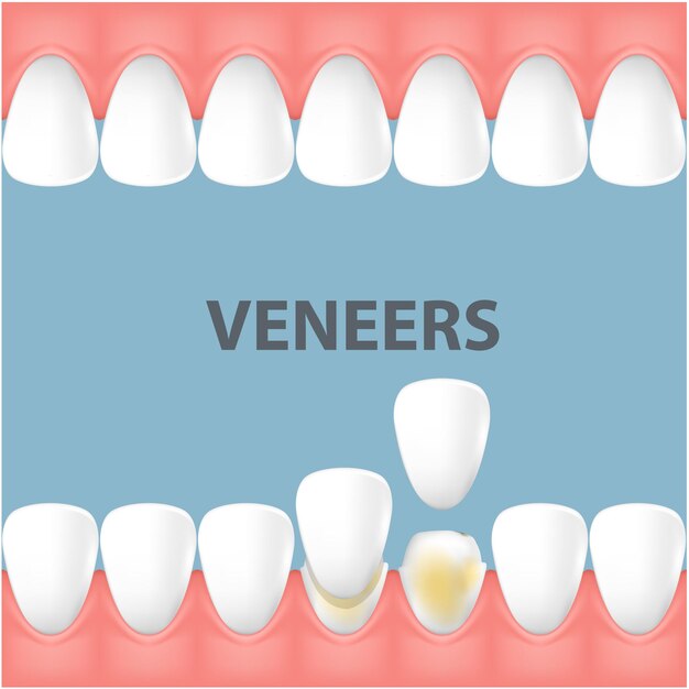 What is the difference between veneer & crown? Dentistry Turkey 