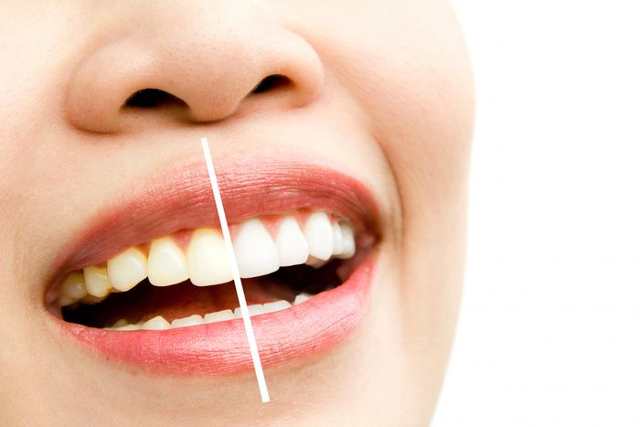 Do Teeth Whitening Strips Really Work?