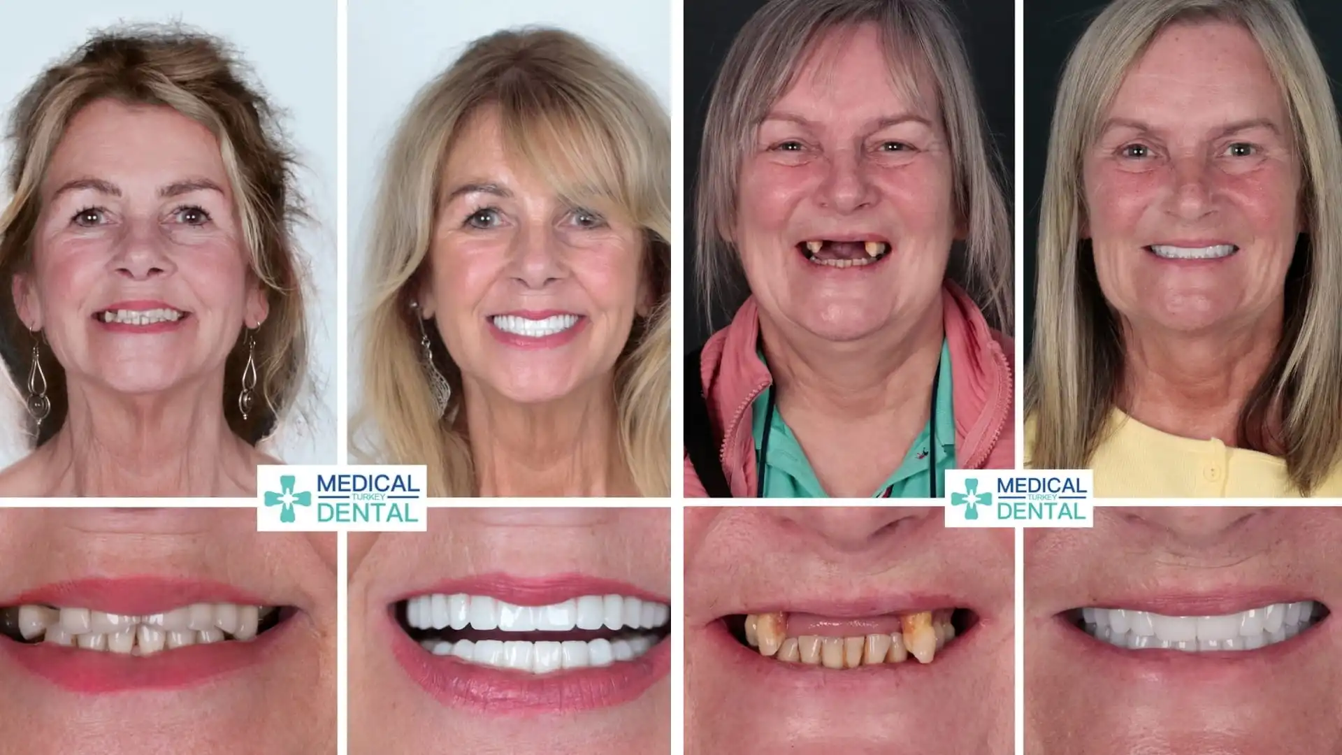Dental implant brand reliable Dental implant brand reliable
