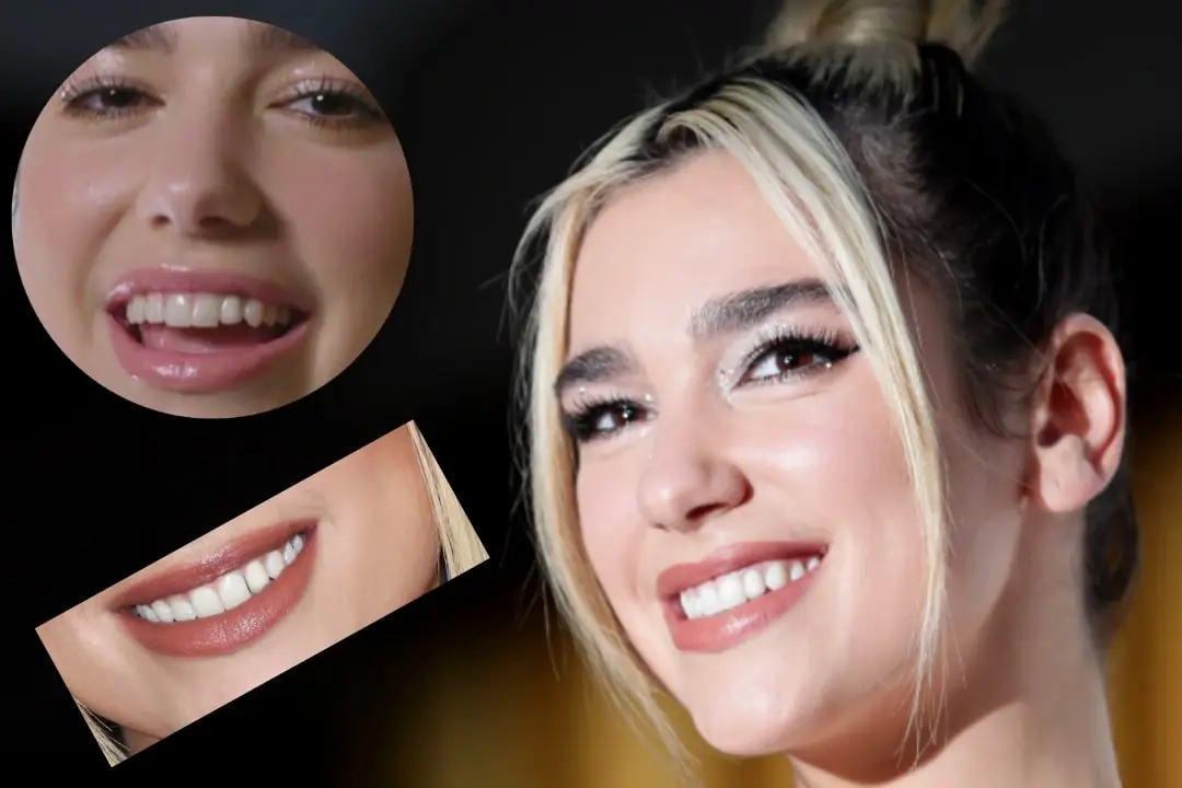 Dua Lipa with veneers before after Dua Lipa with veneers before after