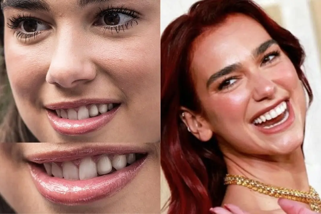 Dua Lipa teeth before after Dua Lipa teeth before after