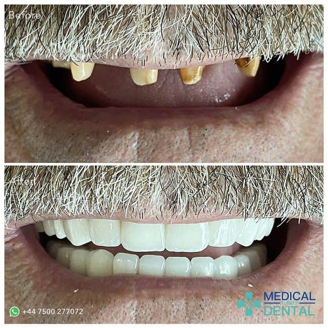 full dental implants before after image