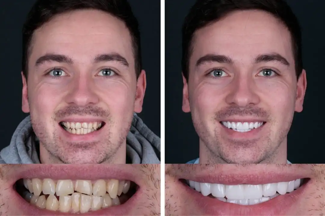 What are Turkey teeth?