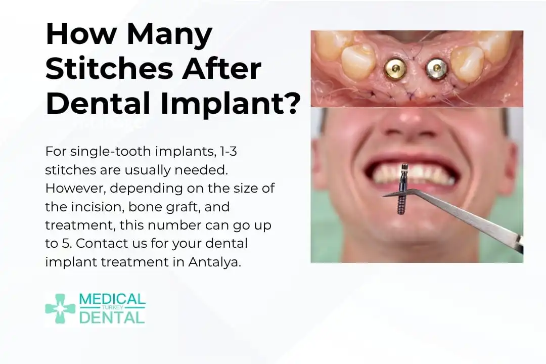 How many stitches are usually placed after a dental implant?