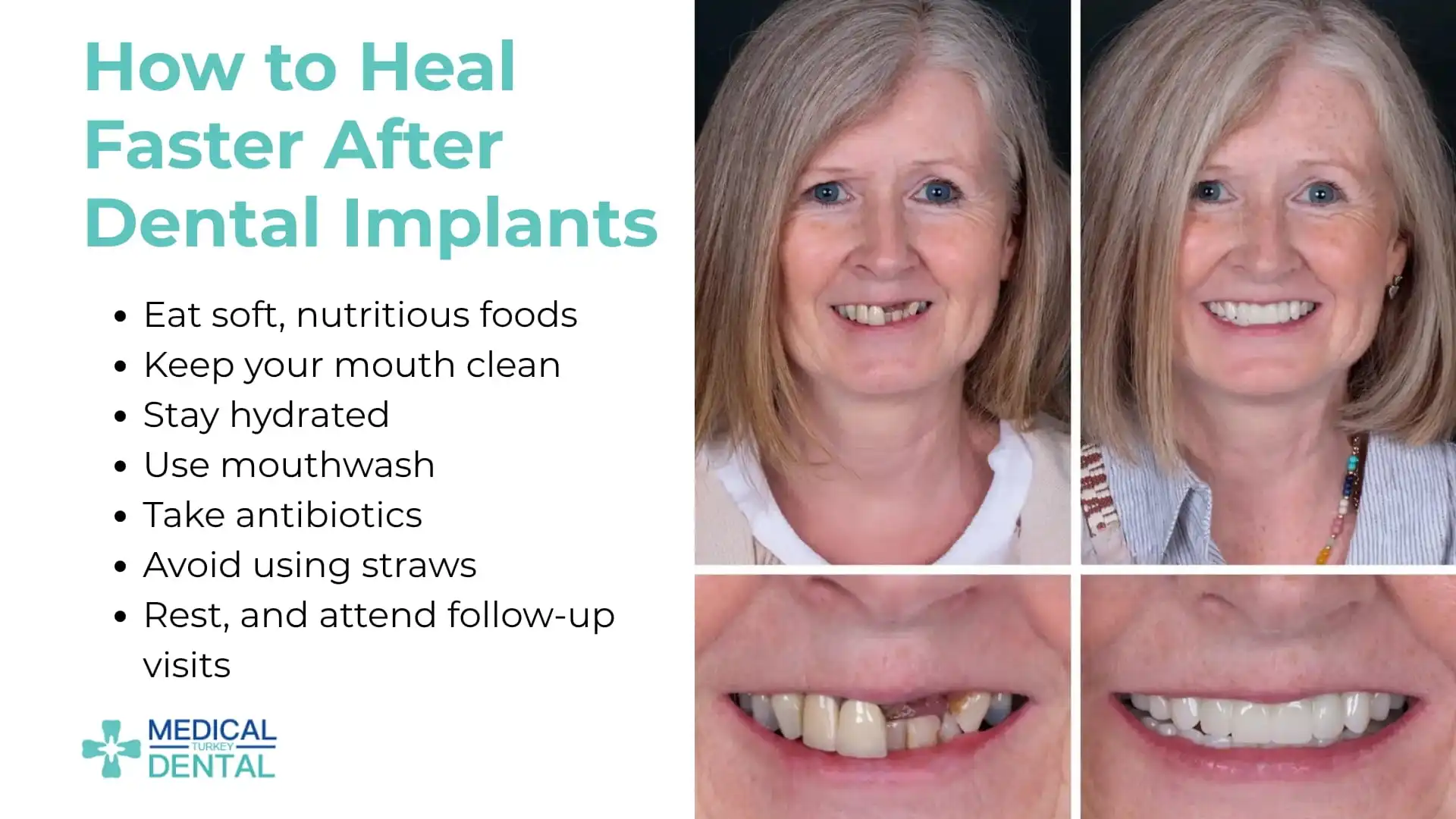 How to heal faster after dental implants in Antalya, Turkey