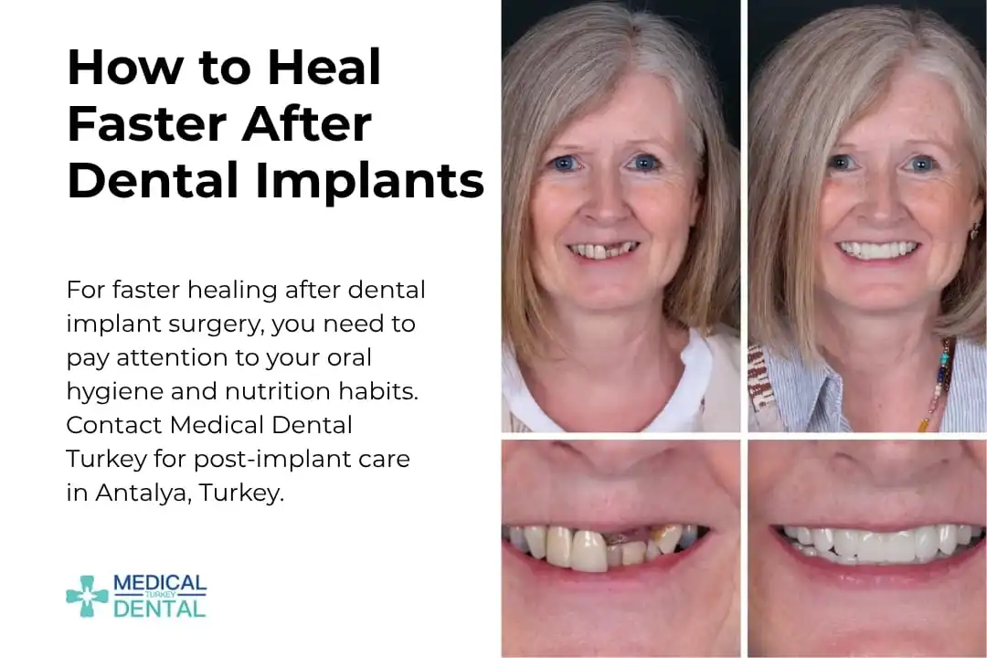 How to Heal Faster After Dental Implants | Medical Dental Turkey
