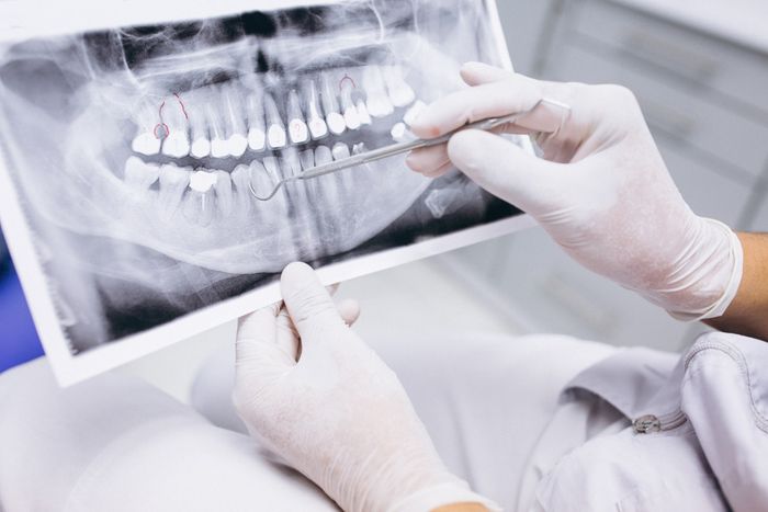 doctor inspect the x ray of teeth who will have Immediate implants 