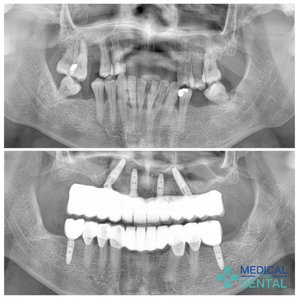 patients teeth x ray iamge who had Immediate implants 