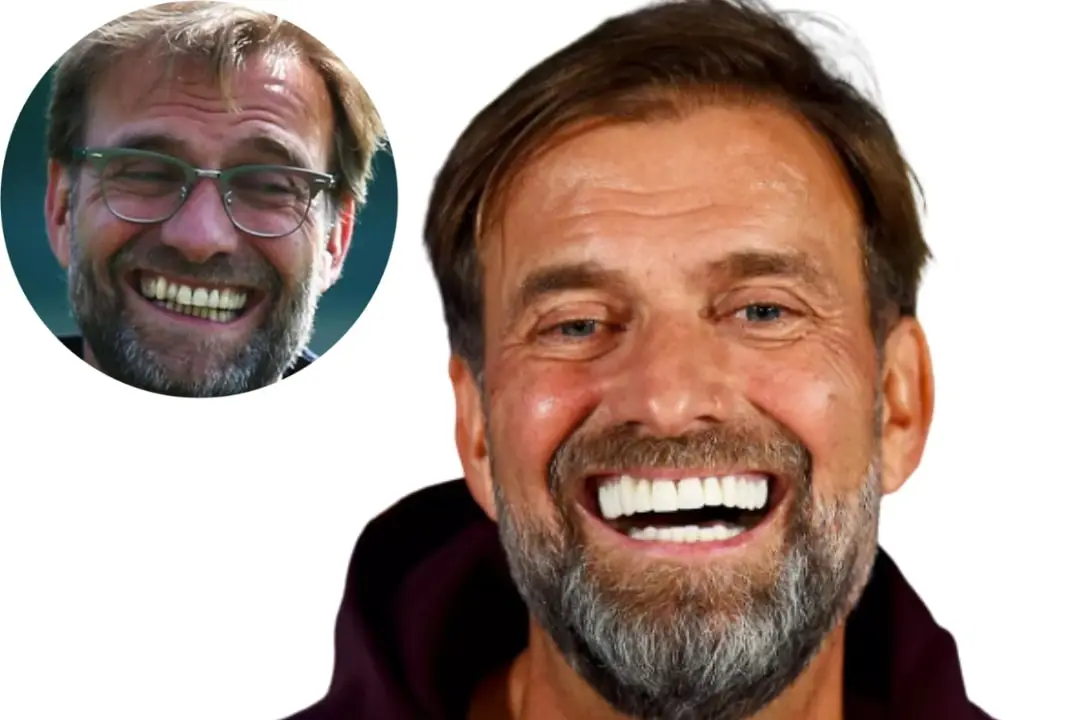 Jürgen Klopp with veneers before after Jürgen Klopp with veneers before after