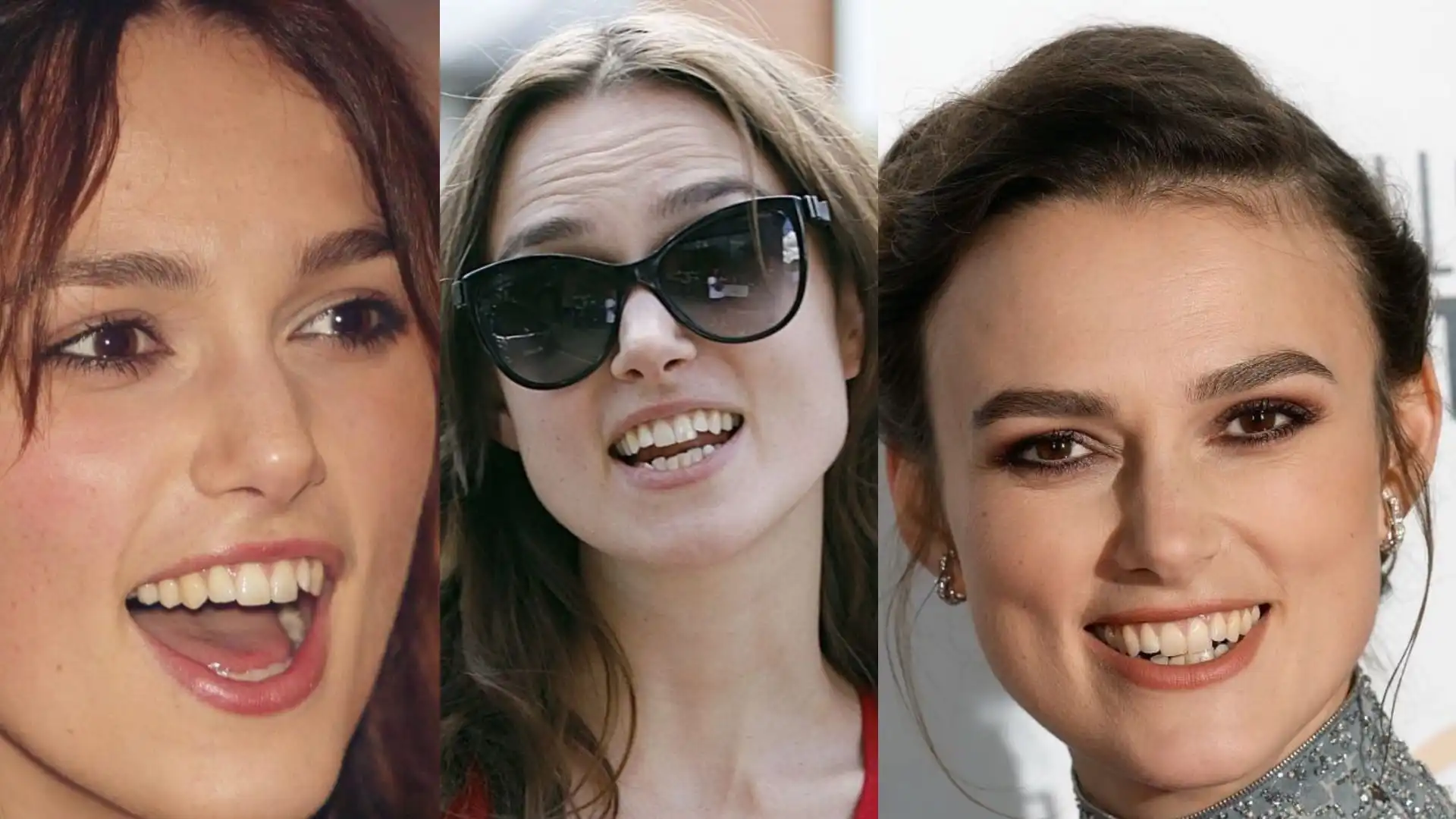 Keira Knightley teeth before after