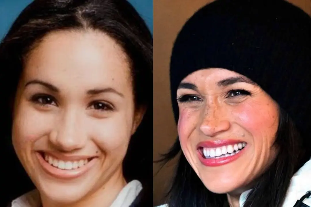 Meghan Markle teeth before after Meghan Markle teeth before after