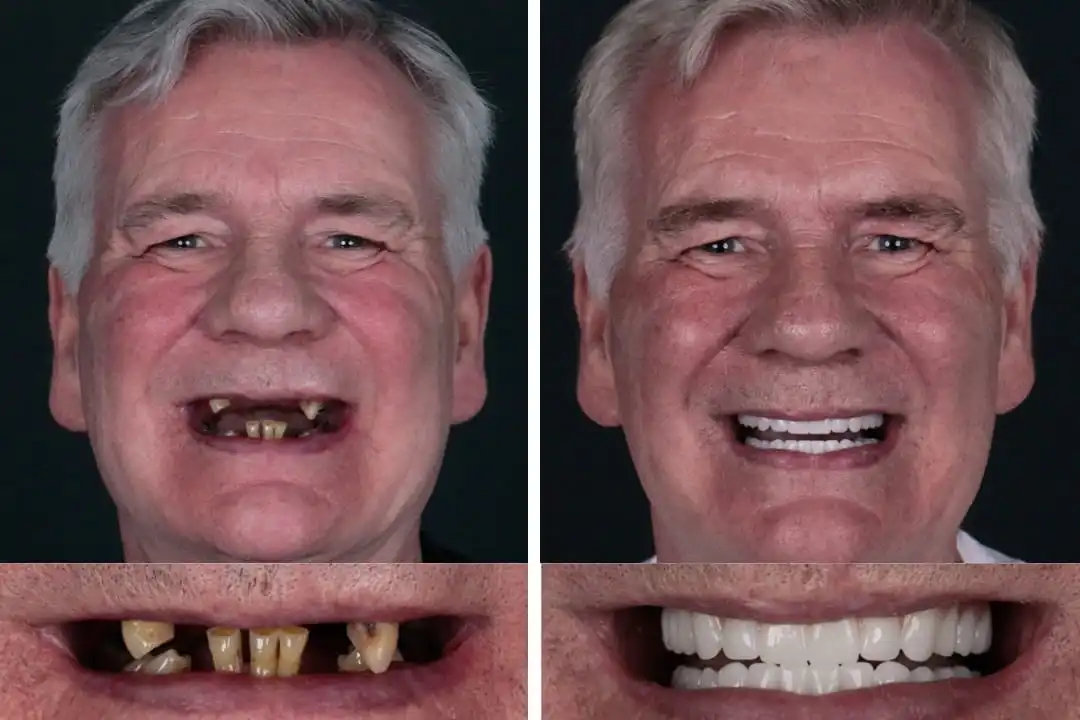 Before after zirconia crown in Antalya, Turkey