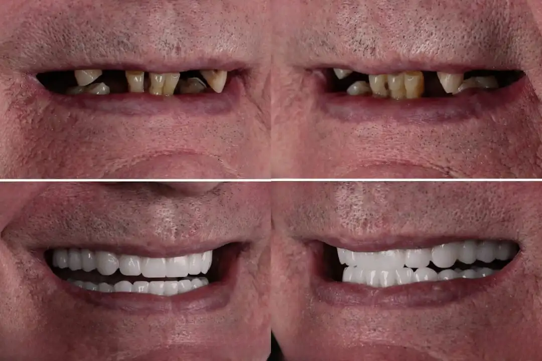 Zirconia crown in Antalya, Turkey before after