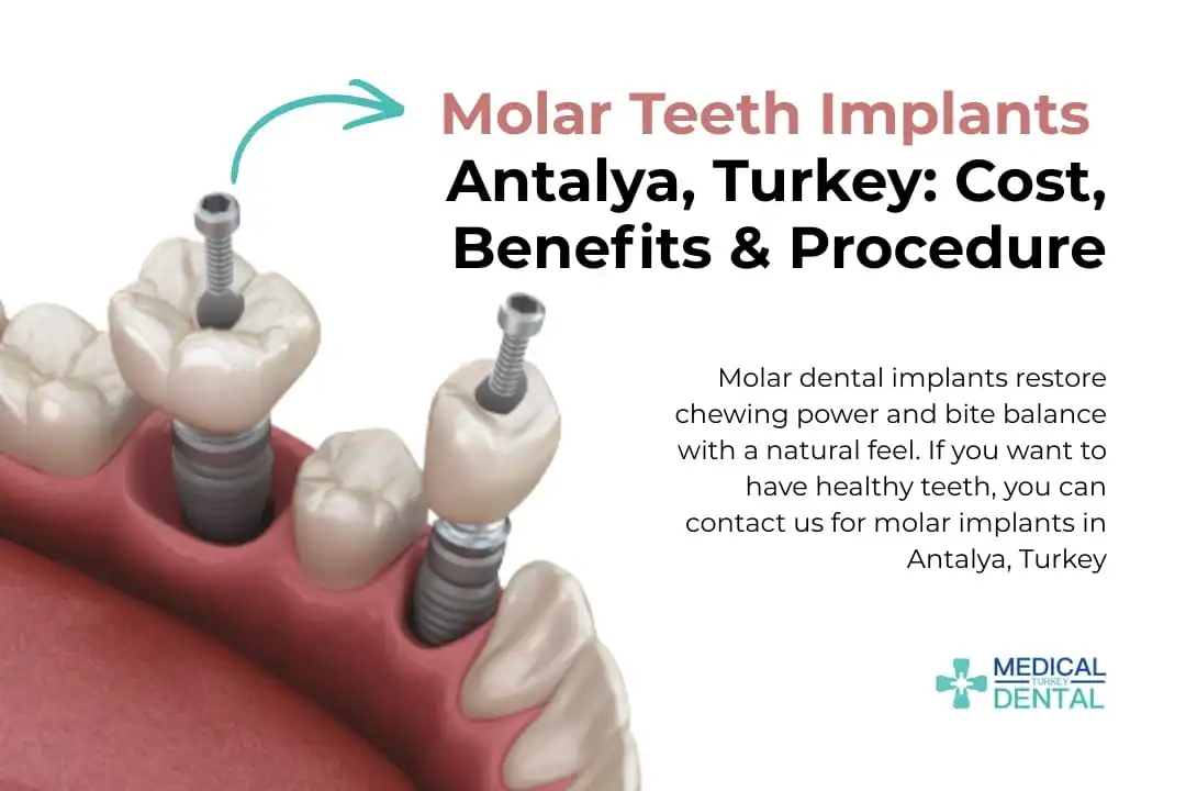 Molar Teeth Implants Antalya, Turkey: Benefits, Cost & Procedure