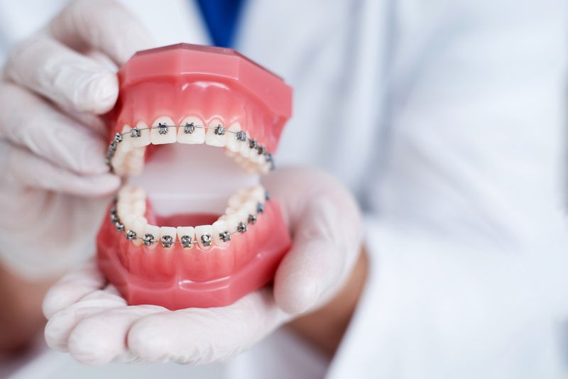 dentist in turkey is showing procedures of dental braces with teeth model