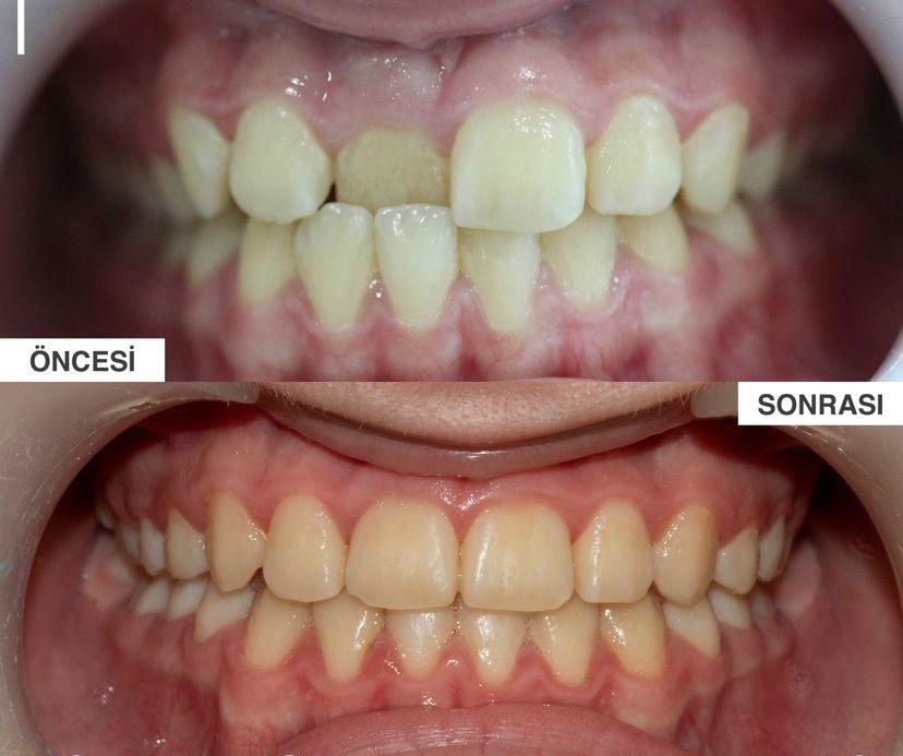 Dental braces before after photo taken by dentist in turkey