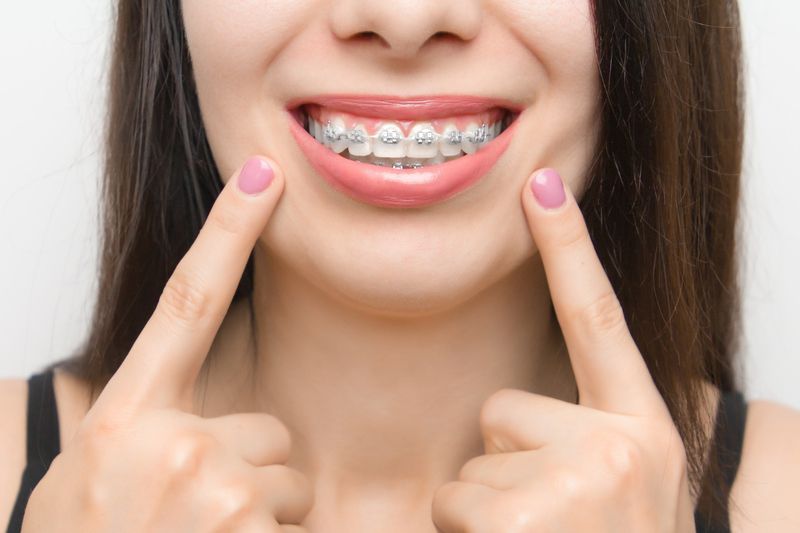 dental braces are on the teeth of a young women