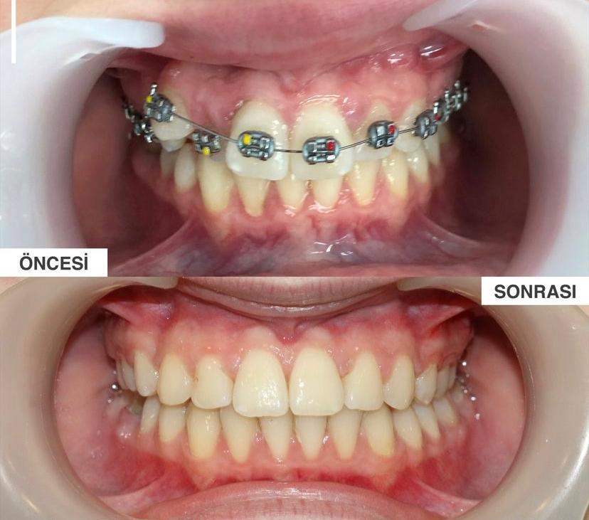 dental braces before after