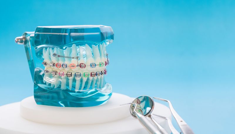 A blue and white teeth model with a dental braces on it.