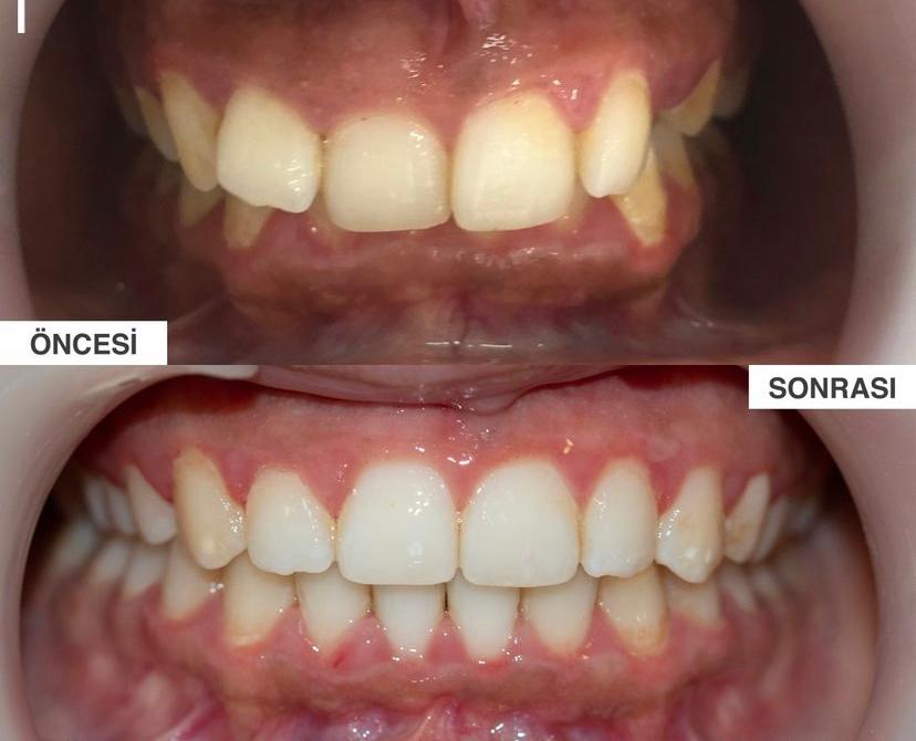 dental braces turkey before after images