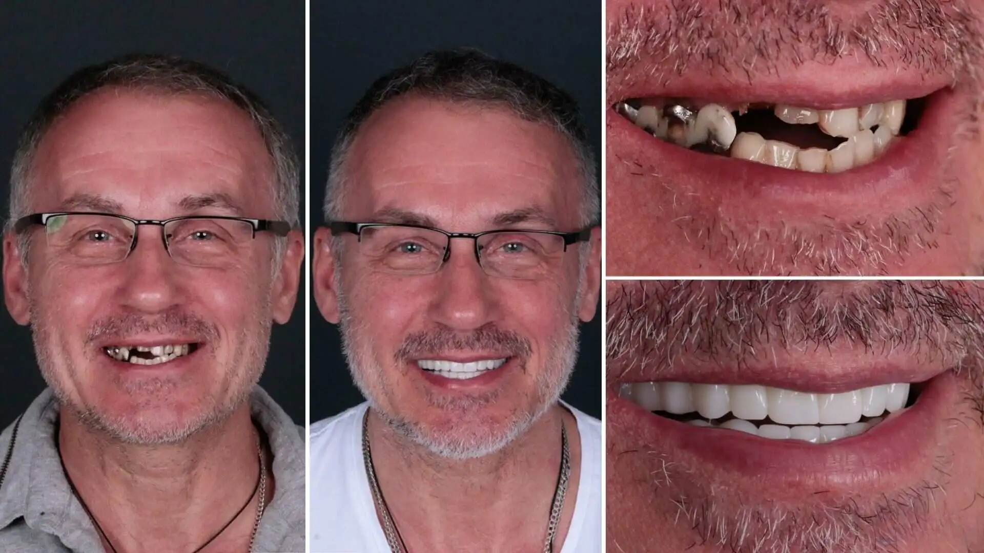 How are rotten teeth treated? Antalya Turkey How are rotten teeth treated? Antalya Turkey