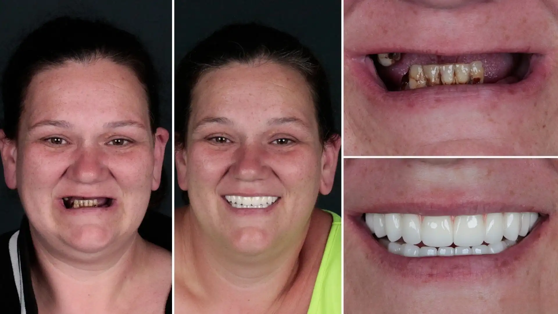 How are rotten teeth treated? Antalya How are rotten teeth treated? Antalya