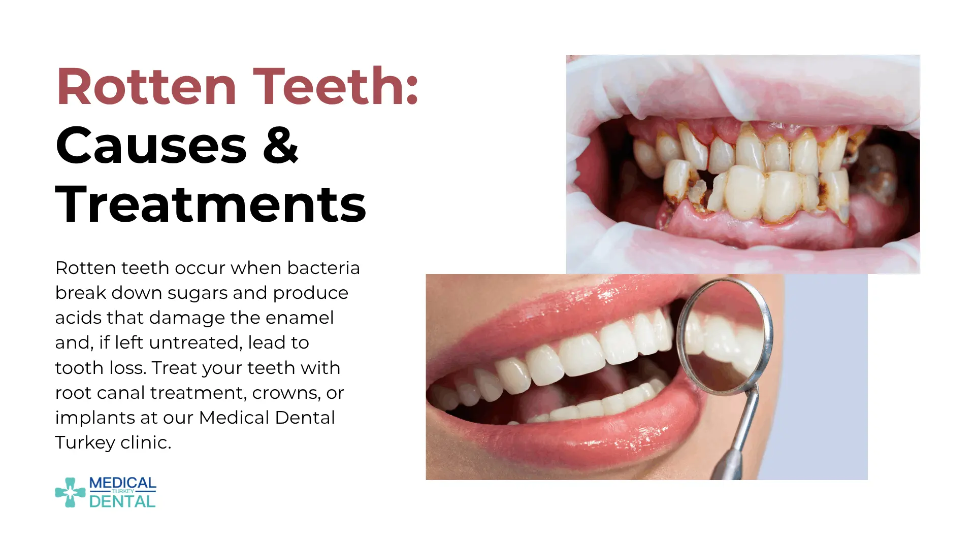 Rotten Teeth: Causes & Treatments Antalya Turkey