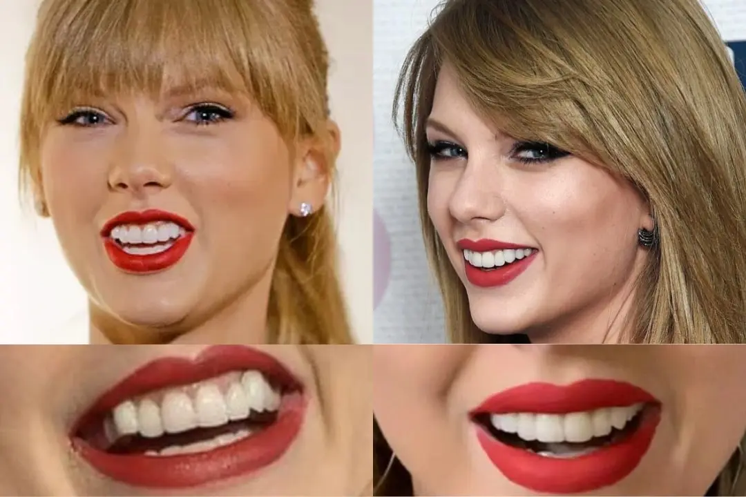 Taylor Swift with veneers before after Taylor Swift with veneers before after