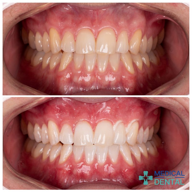 teeth whitening before after image