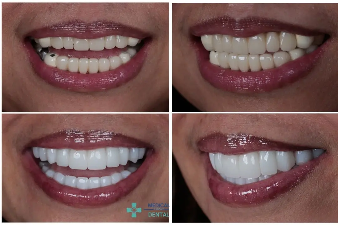 How long do zirconium crowns last?