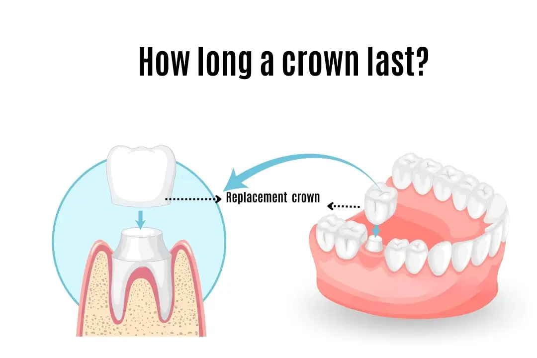 How long do crowns last?