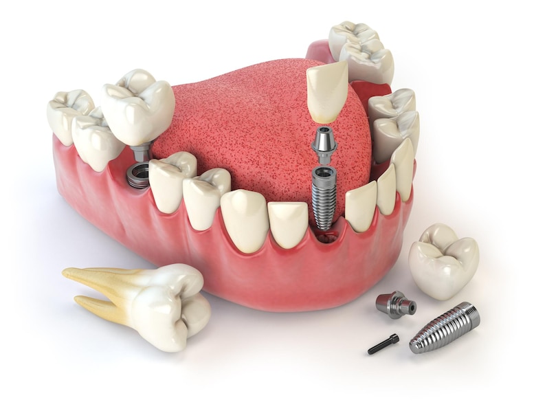 dental-implants-turkey-price-antalya-teeth-implants
