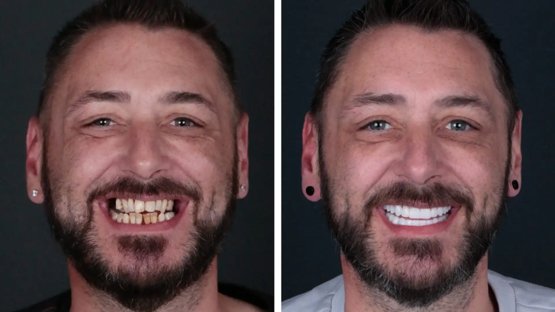 Turkey teeth before and after Turkey teeth before and after