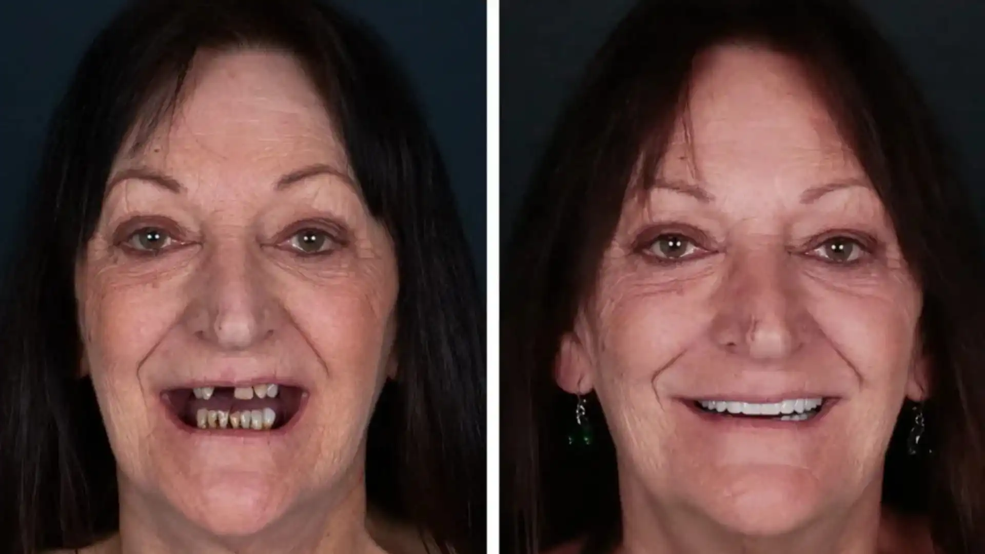 Turkey teeth before and after Turkey teeth before and after