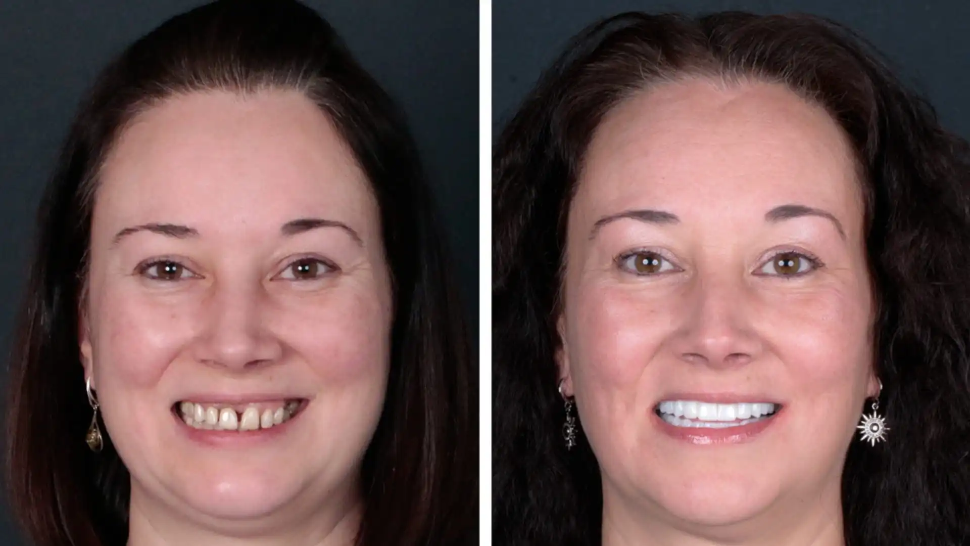 Turkey teeth before and after Turkey teeth before and after