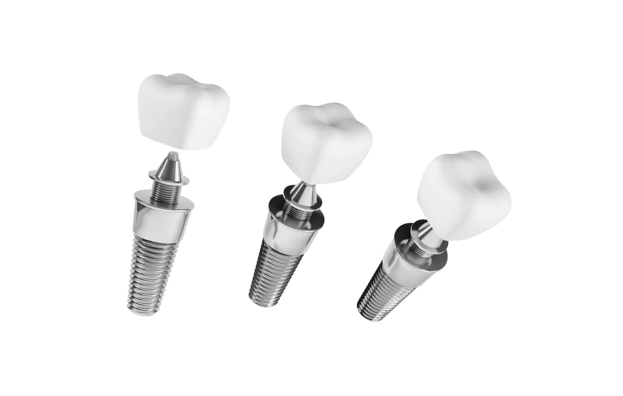Three teeth implants are all together to show side effects of implants