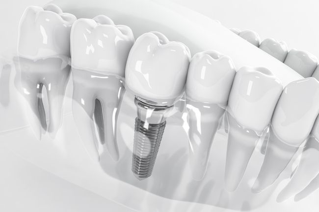 What are the Possible Side Effects of Dental Implants? 