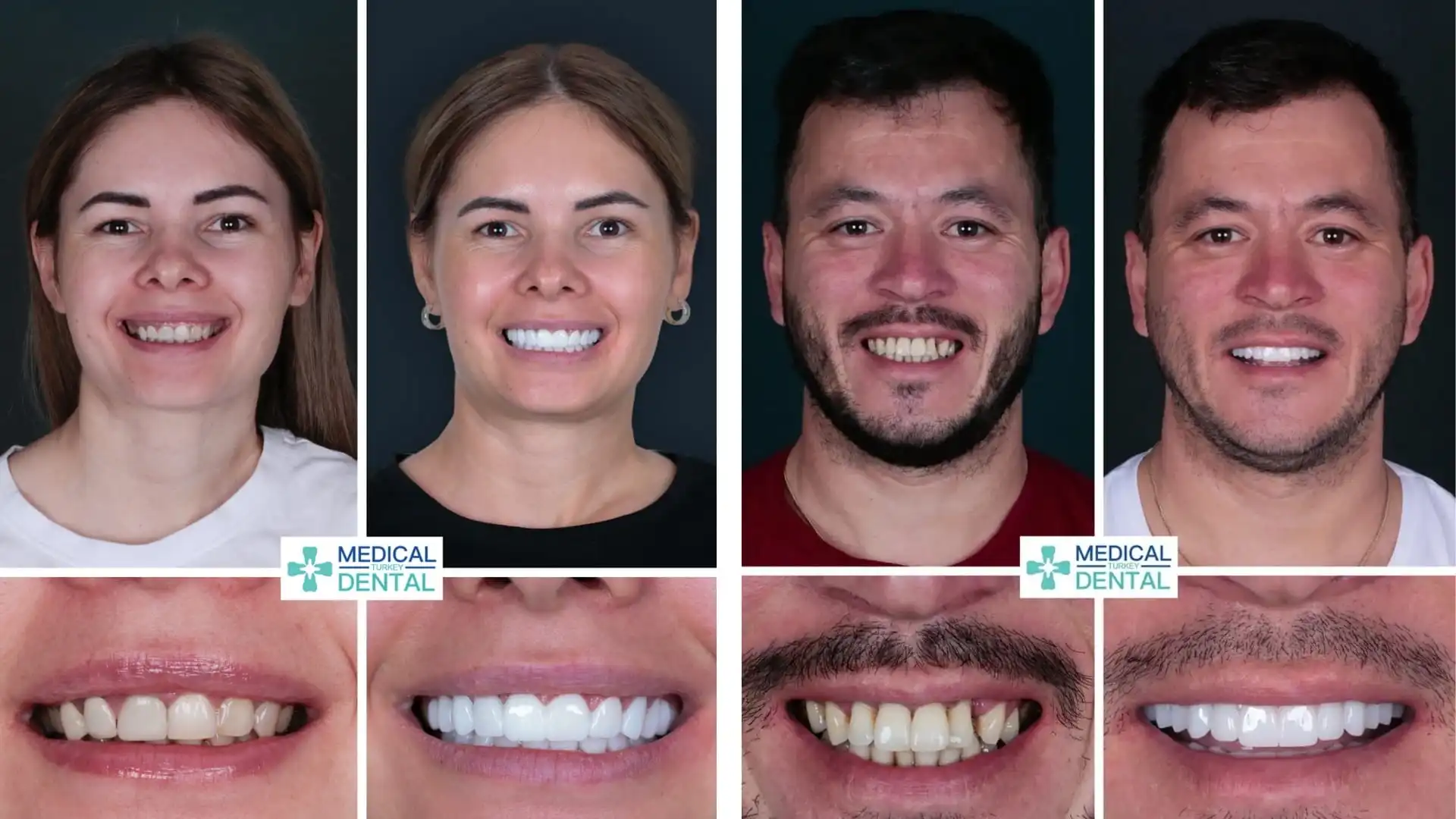 What is the whitest tooth shade?