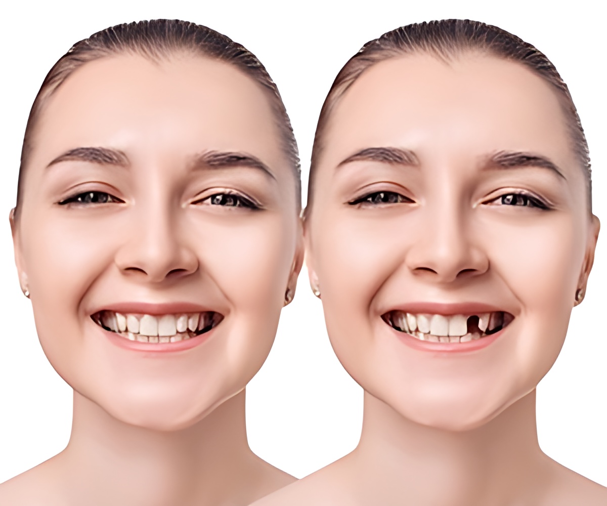 Why is it important to replace missing teeth?,Antalya Dental Clinic