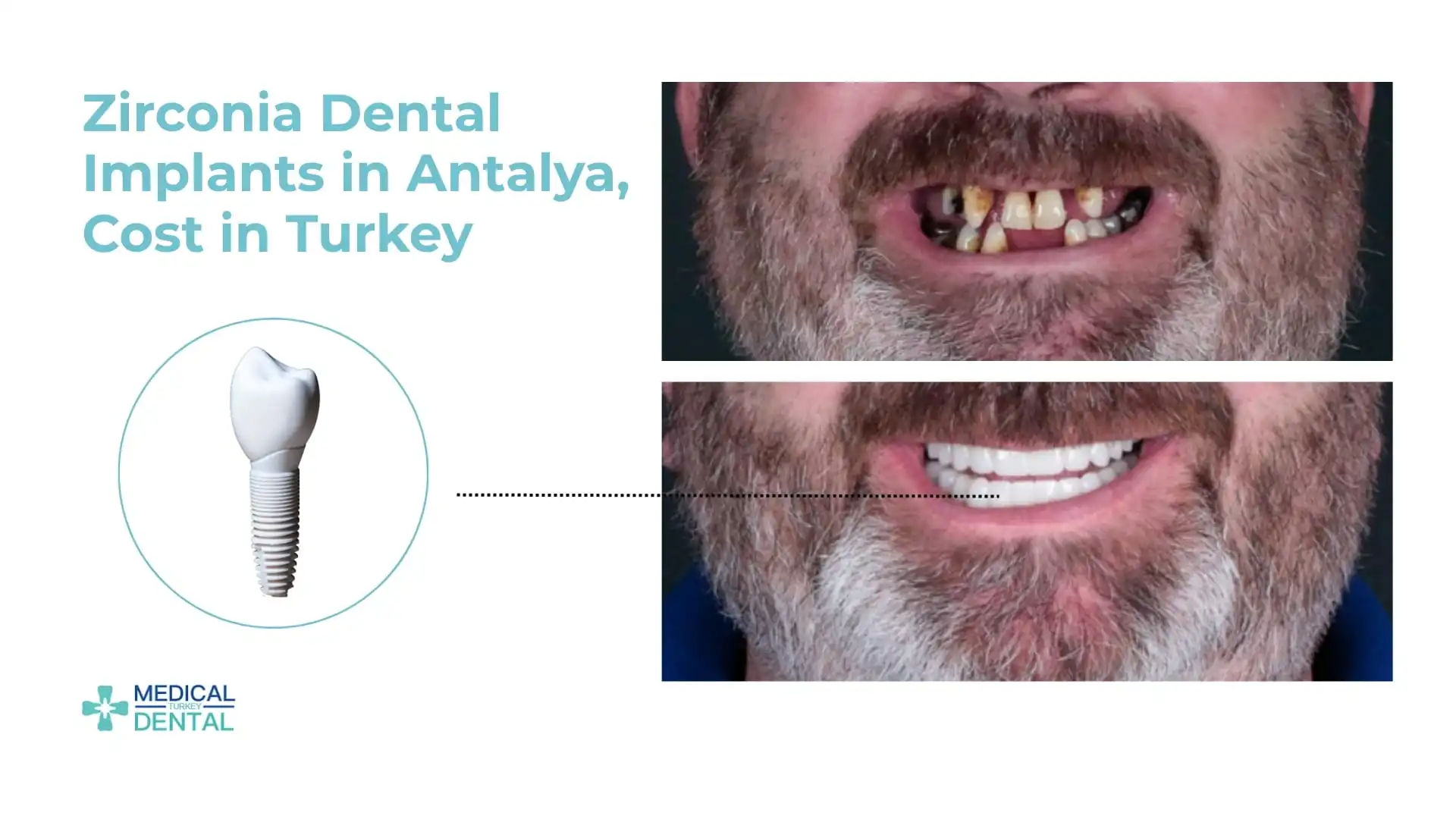 Zirconia dental implants Antalya, Turkey
