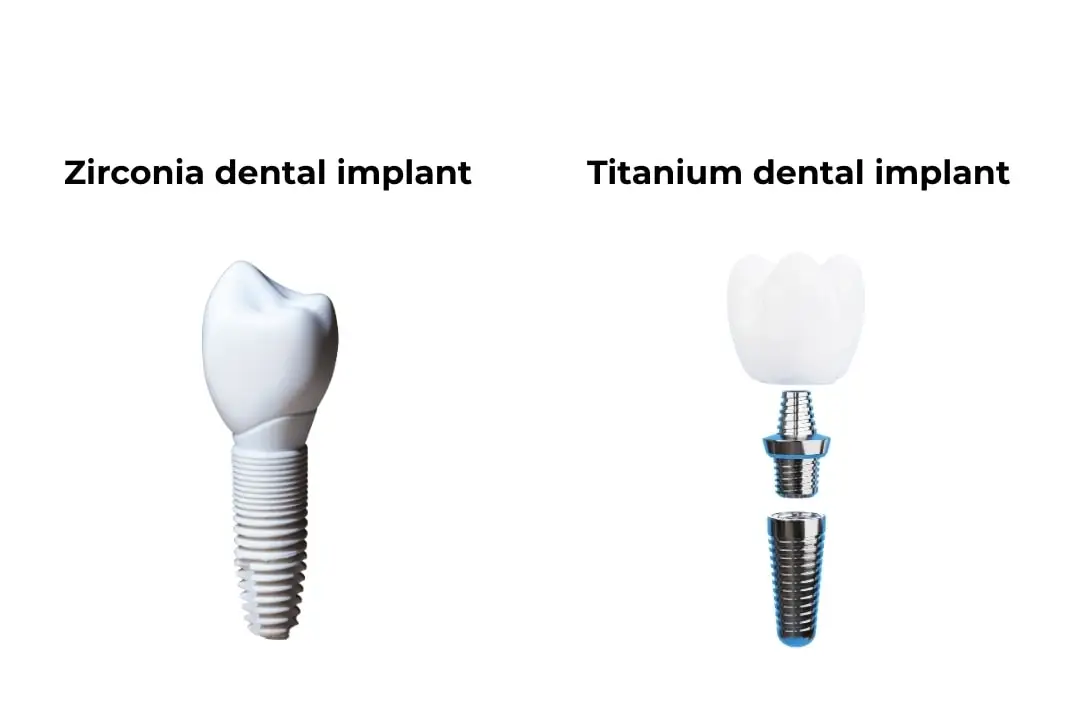 Comparison of titanium and zirconia dental implants Antalya, Turkey