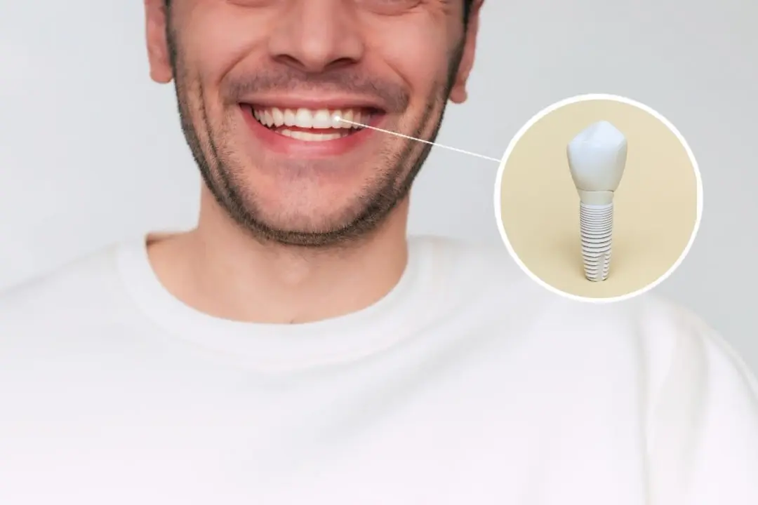 Zirconia dental implants Antalya, Turkey