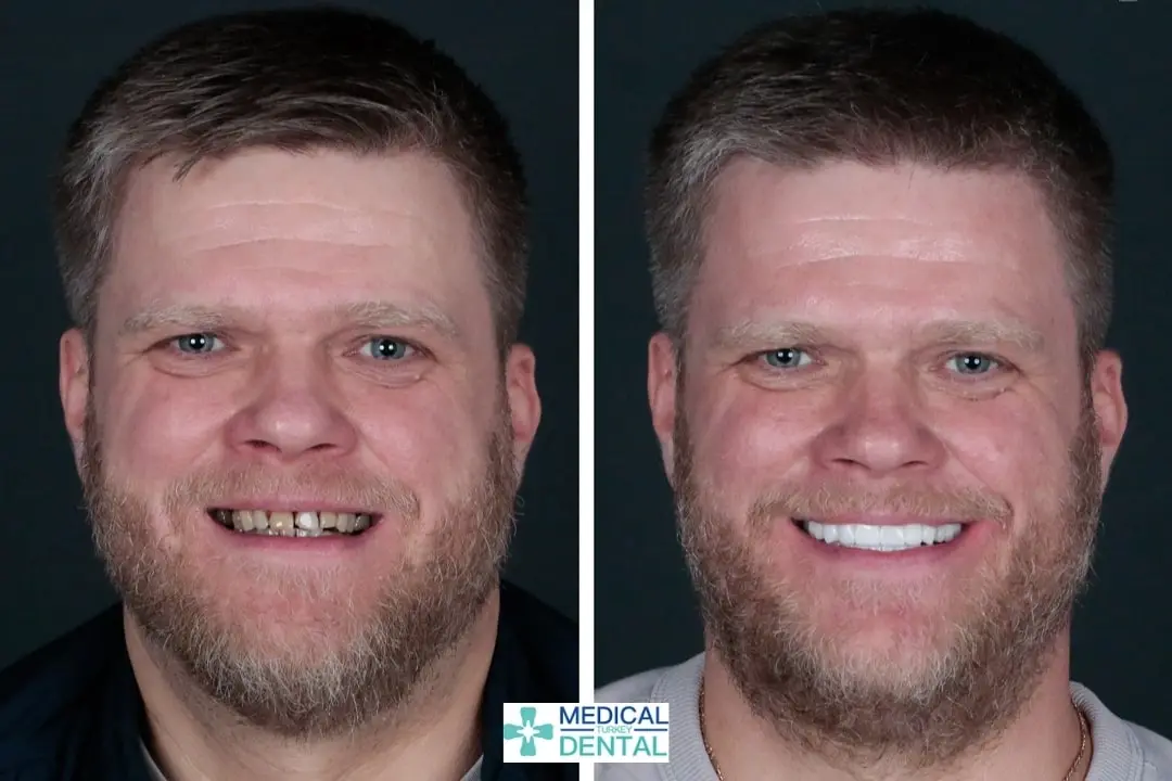 Before after zirconia crown in Antalya, Turkey Before after zirconia crown in Antalya, Turkey
