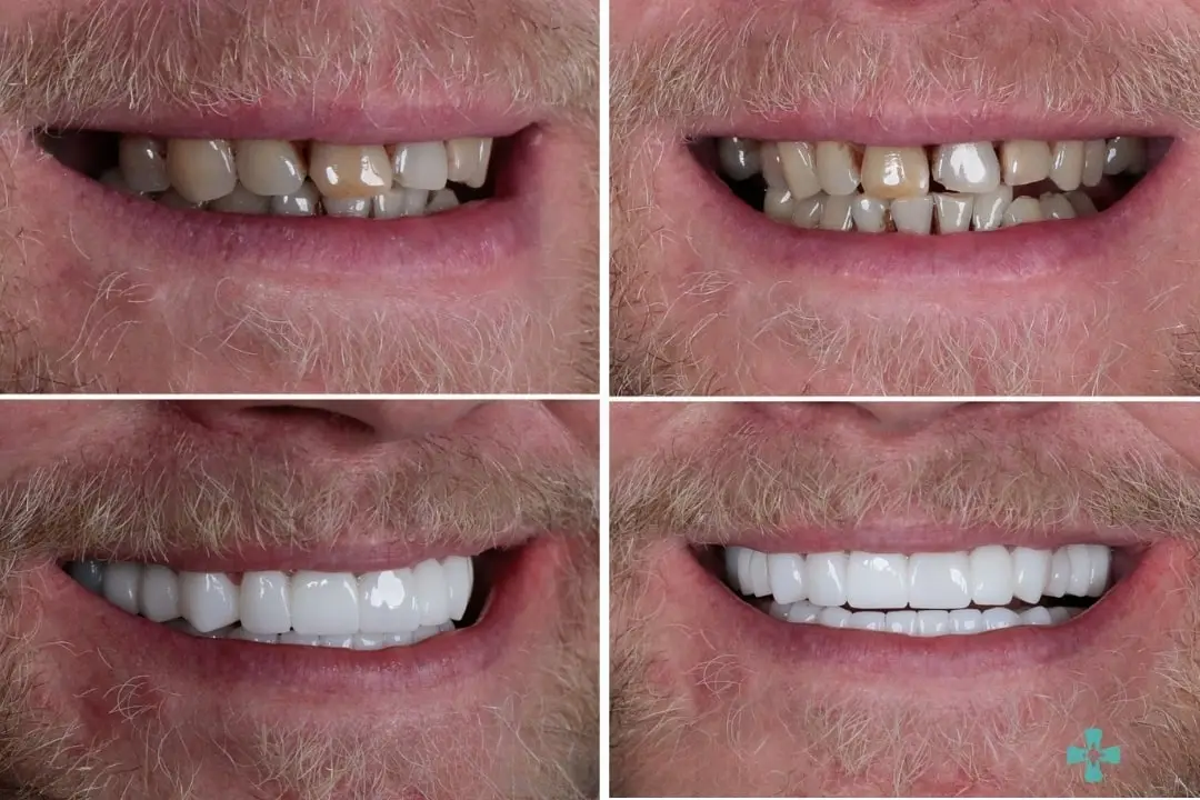 Zirconia crown in Antalya, Turkey before after Zirconia crown in Antalya, Turkey before after