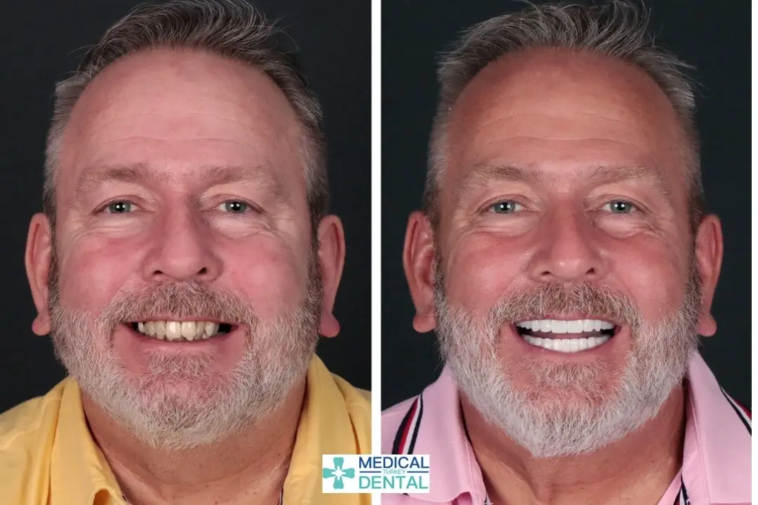 Zirconia crown in Antalya, Turkey before after Zirconia crown in Antalya, Turkey before after