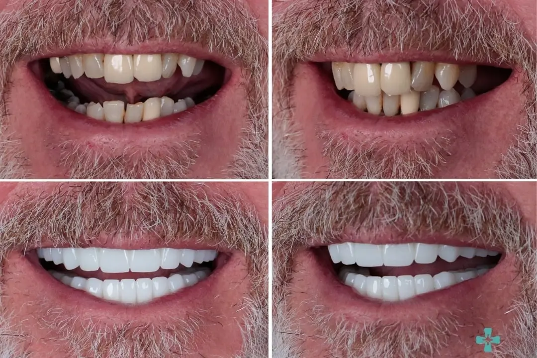 Zirconia crown in Antalya, Turkey before after Zirconia crown in Antalya, Turkey before after