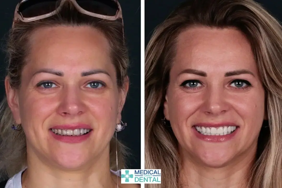 Zirconia dental crown before-after in Antalya, Turkey Zirconia crown in Antalya, Turkey before after