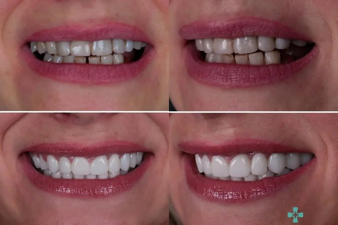 Zirconia dental crown before-after in Antalya, Turkey Zirconia crown in Antalya, Turkey before after