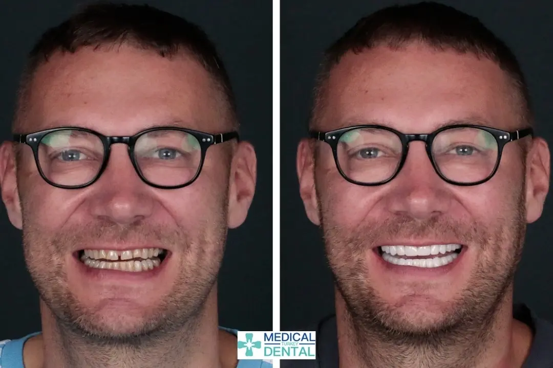 Tooth implant before after Tooth implant before after antalya turkey